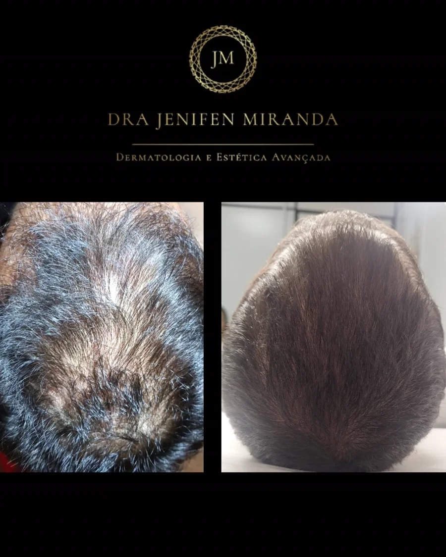 Antes e depois de terapia capilar