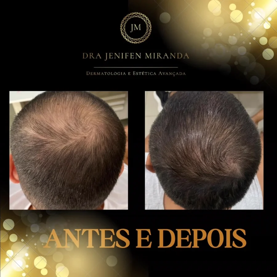 Antes e depois de terapia capilar