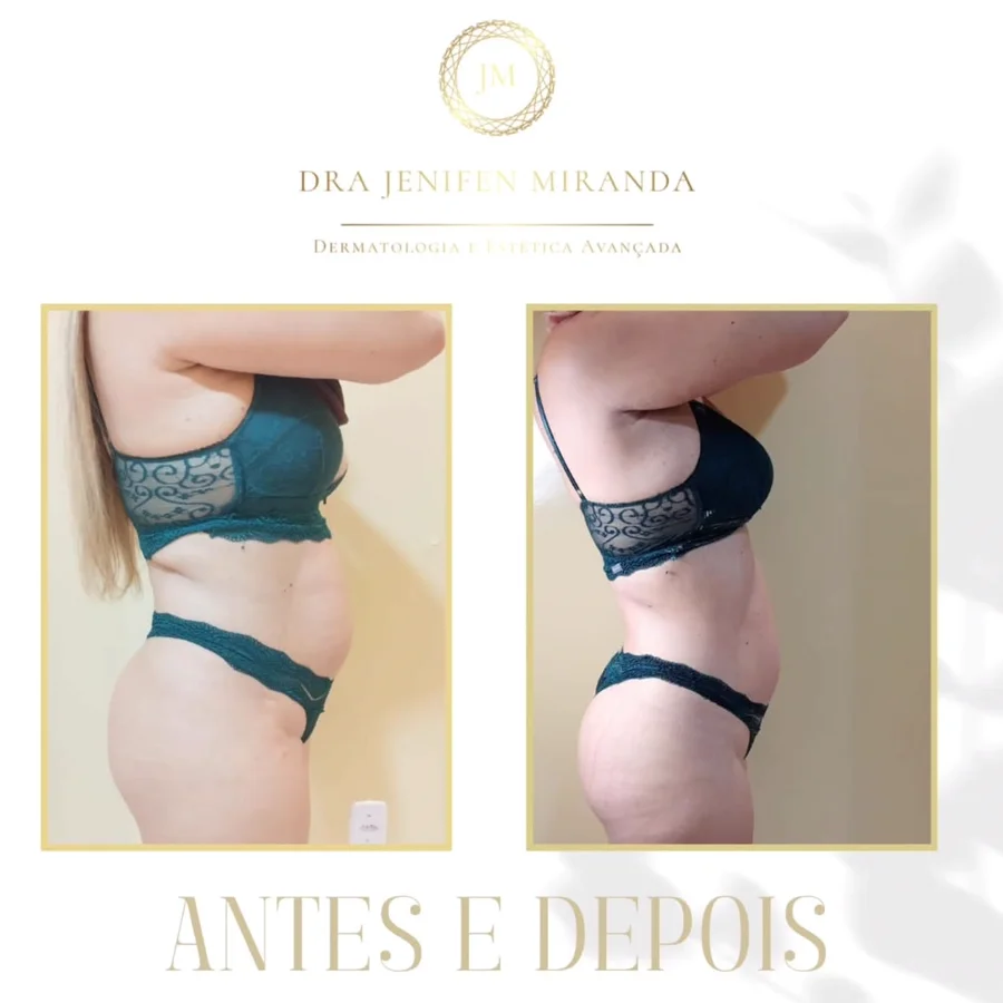Antes e depois de redução de gordura localizada