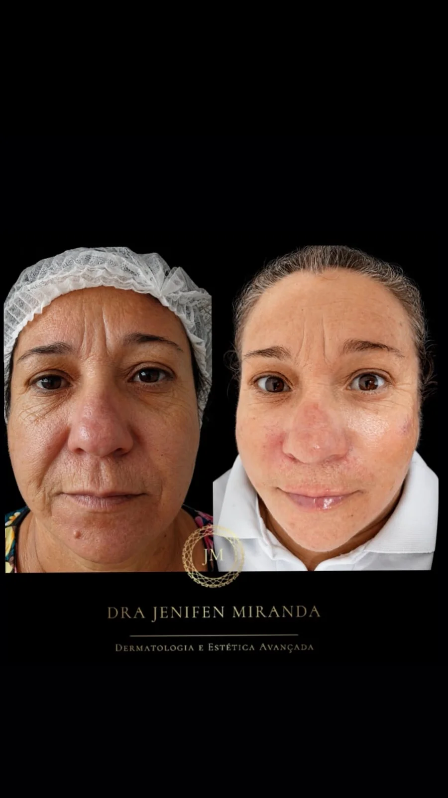 Antes e depois de bioestimulador de colágeno