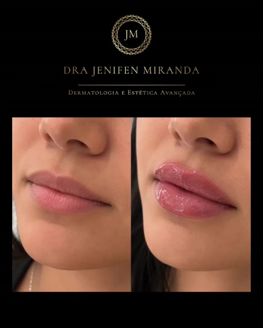 Antes e depois de preenchimento labial