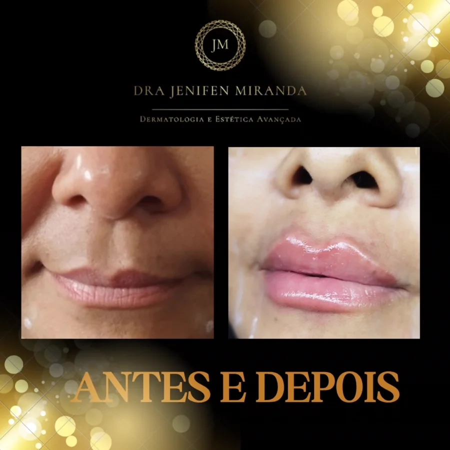 Antes e depois de preenchimento labial