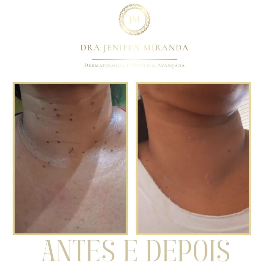 Antes e depois de remoção de lesões de pele no pescoço